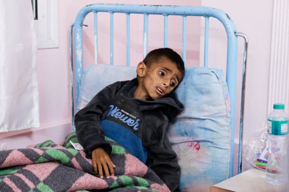 Pięcioletni Palestyńczyk Osama Al-Reqep leczony w placówce medycznej w Gazie