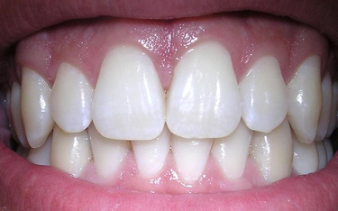 Prawie co dziesiąty maturzysta ma usunięty ząb z powodu próchnicy.