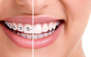 Nowe badanie: Aparat ortodontyczny nie daje żadnych korzyści dla zdrowia jamy ustnej