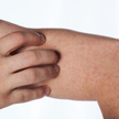 Epidemia odry tuż za polską granicą
