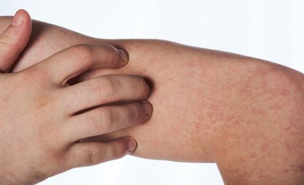 Epidemia odry tuż za polską granicą