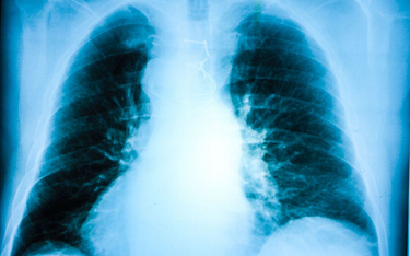 Badania: Zaburzenia czynności płuc wiele tygodni po COVID