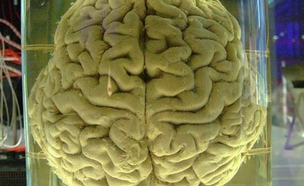 Demencja głodnego mózgu