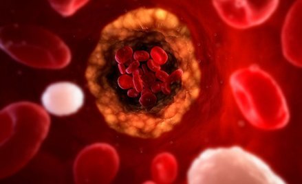 Światło naczyń krwionośnych blokowane przez gromadzącą się blaszkę miażdżycową