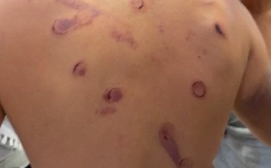 Aktywista z Global Sumud Flotilla pokazywał siniaki i obrażenia po przybyciu na lotnisko w Stambule