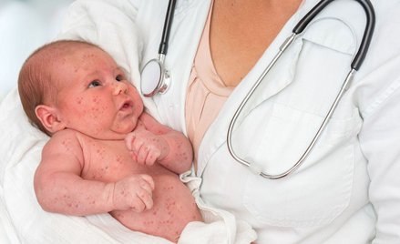 W Polsce już nie ma odporności populacyjnej na odrę