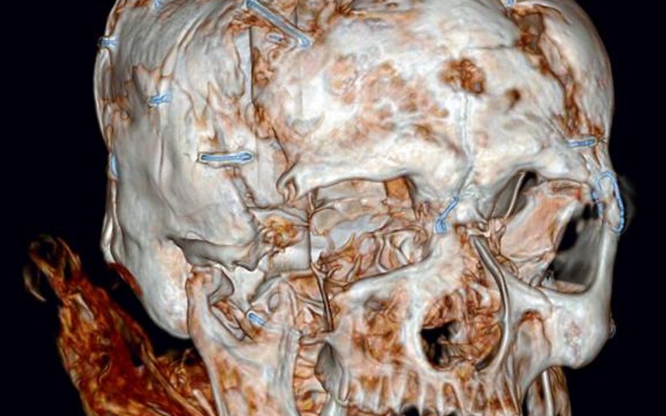 Obraz czaszki Człowieka z Worsley wygenerowany przez tomograf komputerowy