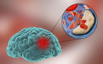 Udar niedokrwienny mózgu, zwany też zawałem mózgu, najczęściej spowodowany jest miażdżycą