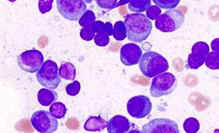 Wielu lekarzy wciąż nie potrafi rozpoznać szpiczaka