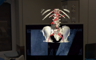 Na podstawie danych z tomografu tworzony jest trójwymiarowy hologram organu