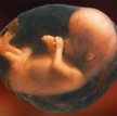 Rośnie liczba aborcji. Więcej wykrywanych wad płodów