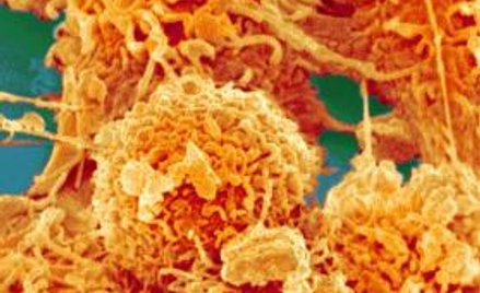 Białko Ras jest zmutowane w jednej trzeciej wszystkich guzów