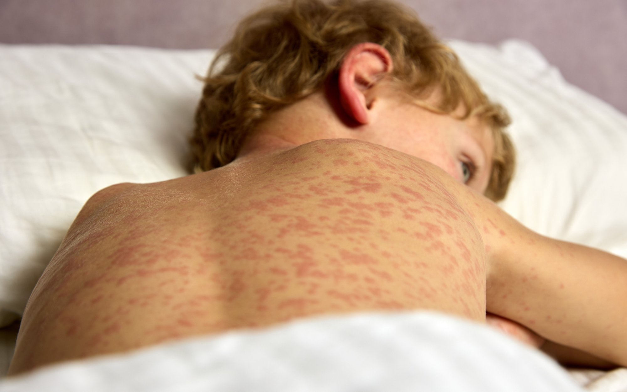 Choroba, która w 2000 roku zniknęła z USA, znów zabija. Zmarło dziecko