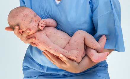 Epidemia odry w Czechach: ratownicy już nie potrzebują wojska