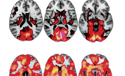 Sieć stanu spoczynkowego: placebo (góra) i LSD (dół)