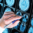 Leqembi, nowy lek na chorobę Alzheimera