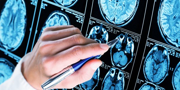 Wystarczy rozmowa. AI potrafi już wykryć Alzheimera w minutę, bez testów