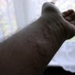 reakcja alergiczna