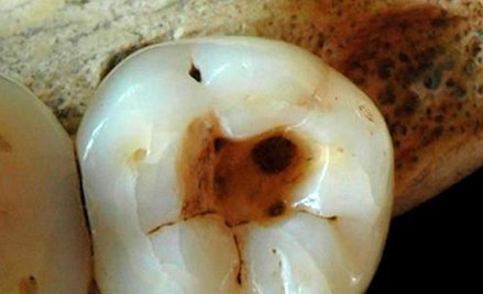 Ludzki ząb ze śladami interwencji dentystycznej sprzed 14 tysięcy lat.