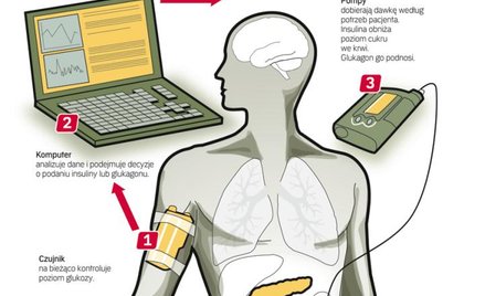 Podstawową zaletą systemów z tzw. zamkniętą pętlą jest ciągłe monitorowanie poziomu cukru we krwi. P