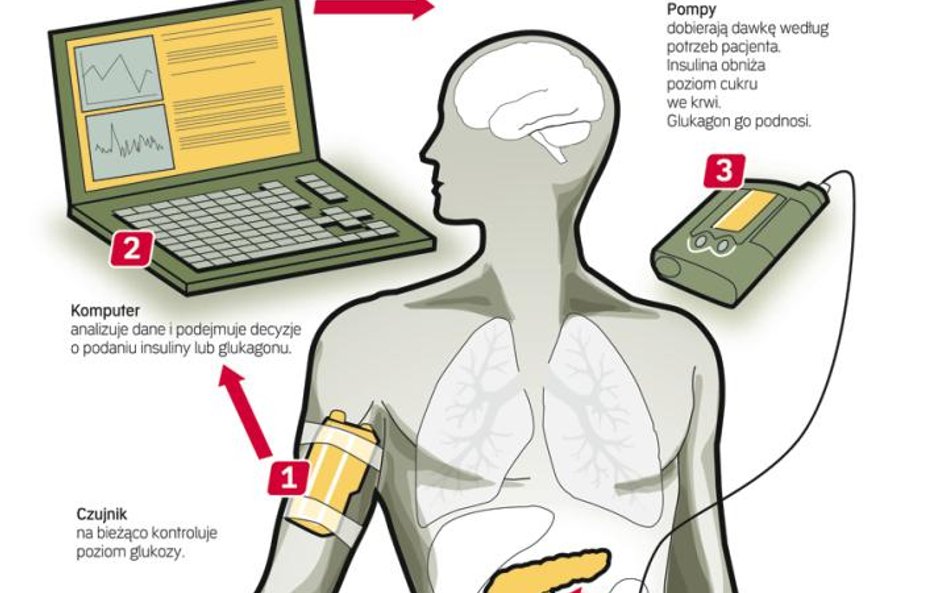 Podstawową zaletą systemów z tzw. zamkniętą pętlą jest ciągłe monitorowanie poziomu cukru we krwi. P