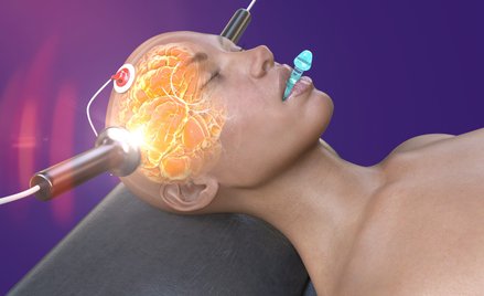 Terapia elektrowstrząsami jest jednak skuteczna u aż 80 proc. pacjentów, którzy ją otrzymują, najczę